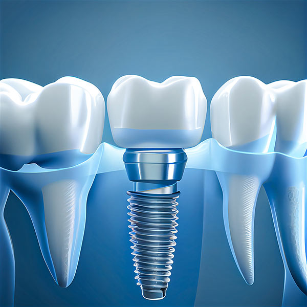 Implanty Zębów – powrót Pięknego Uśmiechu